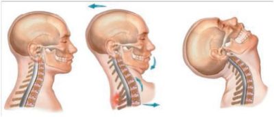 DC-Whiplash-Injury-Lawyer-.jpeg